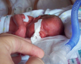 Premature Baby with incubator