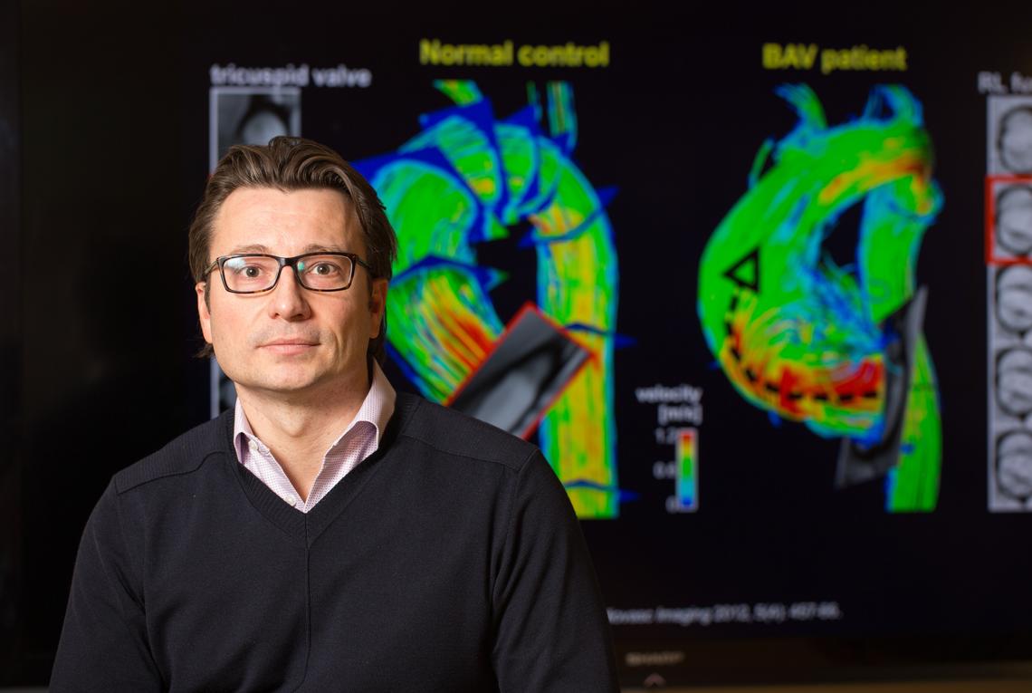 Using high-tech 4D-Flow MRI imaging, Paul Fedak, Cumming School of Medicine, will co-lead a study on bicuspid aortic valves (BAV) which could cut down on the number of unnecessary open-heart surgeries while also identifying and targeting those who are at highest risk and need it most.