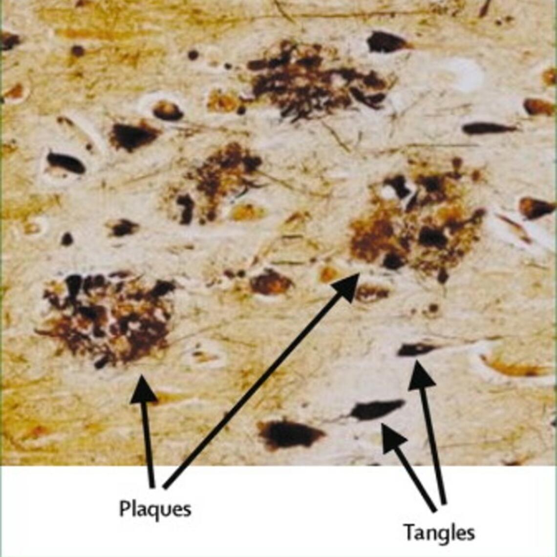Silver stained section of an AD brain