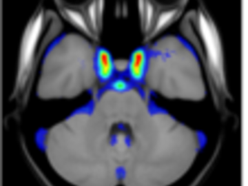 Probabilistic vessel atlas